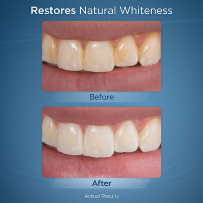 Whitening water flosser before and after