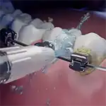 Flossing braces with a Waterpik™ Water Flosser