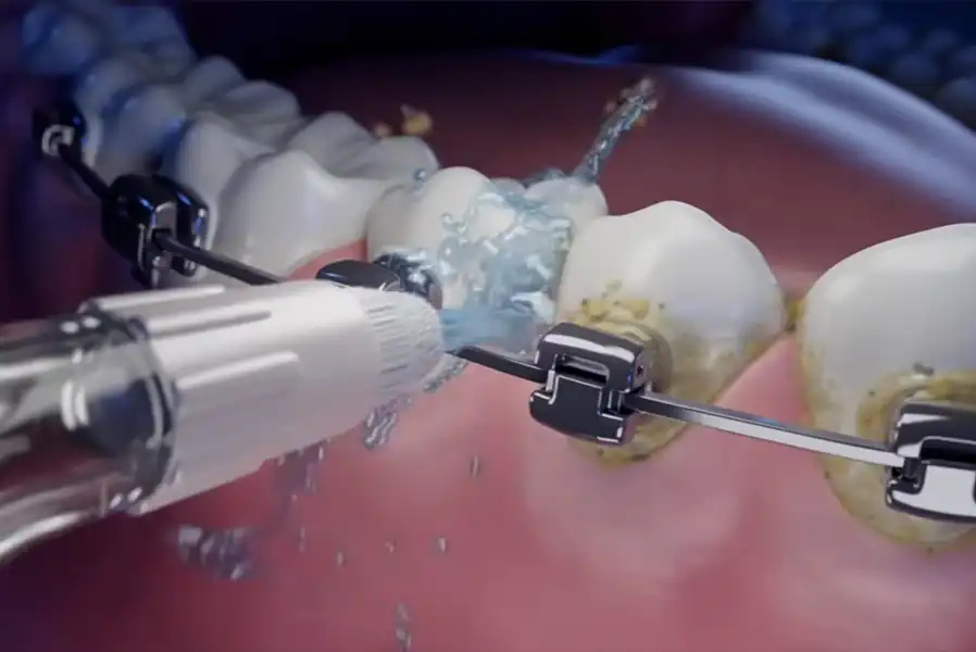 Flossing braces with a Waterpik™ water flosser