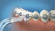 Water flosser Orthodontic tip cleaning teeth with dental braces to remove plaque around brackets and wires.