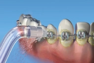 Water flosser Orthodontic tip spraying water around teeth with orthodontic brackets.