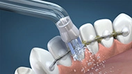 Close-up of the water flosser Plaque Seeker tip spraying water around teeth that have a dental retainer.