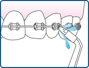 Step 5 diagram demonstrating how to use a water flosser on teeth with dental braces to clean around orthodontic brackets and wires.