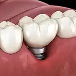 Tooth and gums with implant tooth showing