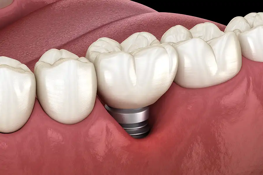 Tooth and gums with implant tooth showing