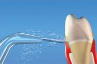 Close-up of a water jet spraying along the gumline of a tooth to demonstrate water flosser cleaning action.