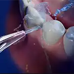 Water flosser tip with water pulsating