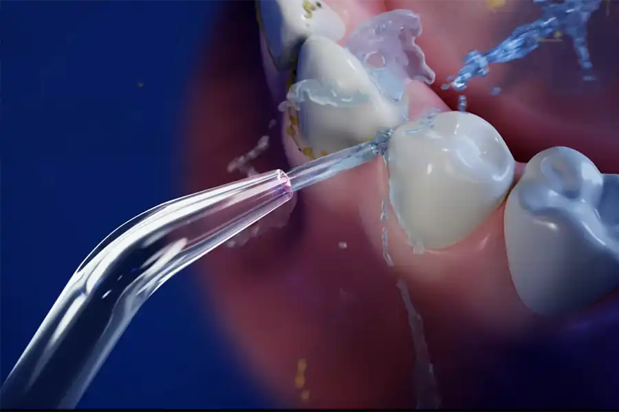 Illustration of a Waterpik™ water flosser tip shooting water at the gumline of a tooth and dislodging plaque and debris