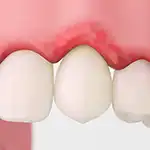 Tooth in inflamed gum
