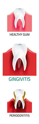 Diagram illustrating the three stages of gum disease and progression of inflammation and tissue damage: 1. healthy gums, 2. gingivitis, 3. periodontitis.