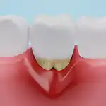 Tooth in inflamed gum