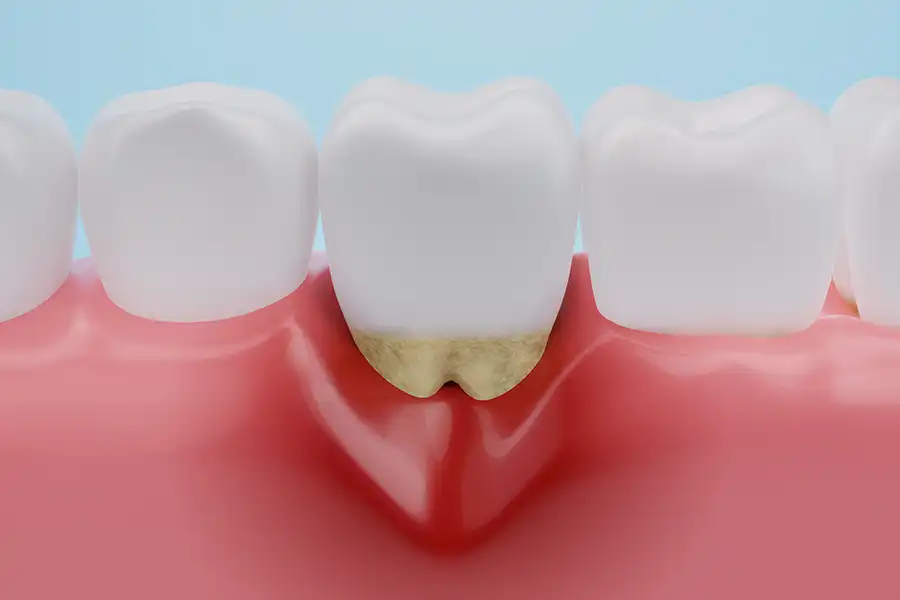 Tooth in inflamed gum