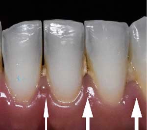 Teeth with plaque buildup demonstrated by white arrows, illustrating the consequences of not flossing for two weeks.