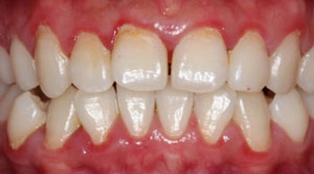 Close-up of teeth and red, inflamed gums.