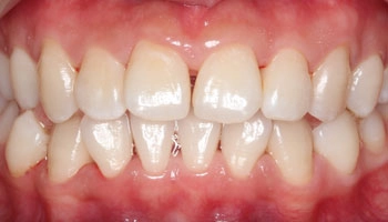 Close-up of teeth and healthy pink gums.