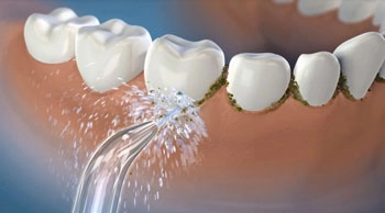 Close-up of a water flosser tip in action, with a water stream spraying along the gumline cleaning interdental spaces.