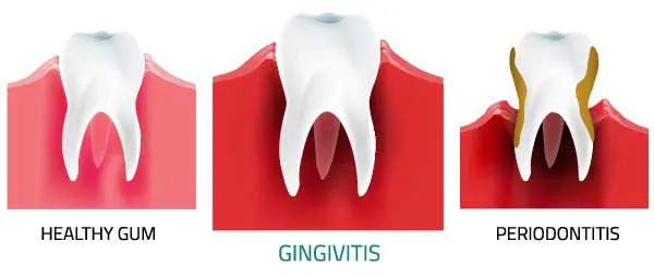 Three illustrations of a cross section of a tooth and surrounding gum tissue going from healthy, to gingivitis, to periodontitis. The tooth changes from white to having brown sides, the gum tissue goes from healthy pink to an inflamed red, with visible gum pockets.