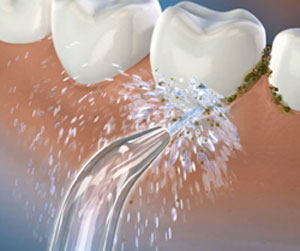 Illustration of a Waterpik® Water Flosser tip shooting water at the gumline of a tooth and dislodging plaque and debris