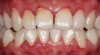 Teeth with gum disease