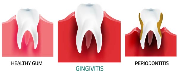 Gingivitis - treatment, symptoms, causes