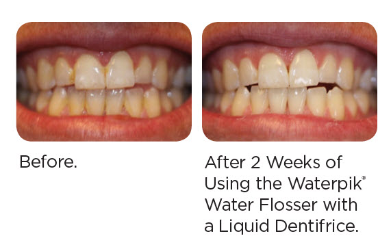 Waterpik Before And After