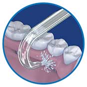 Implant Denture Tip DT-100E